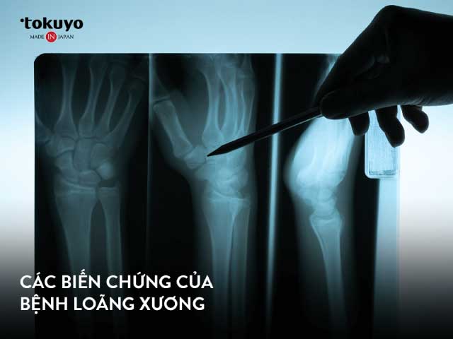 biến chứng của bệnh loãng xương